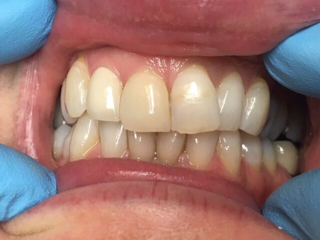 Crowns/Veneers Before