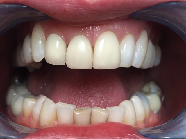 Crowns/Veneers After