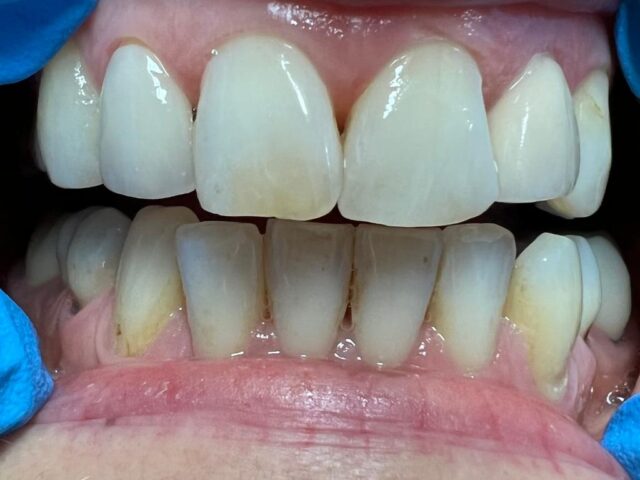 veneers-1a