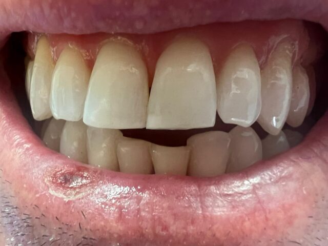 white-fillings-2a