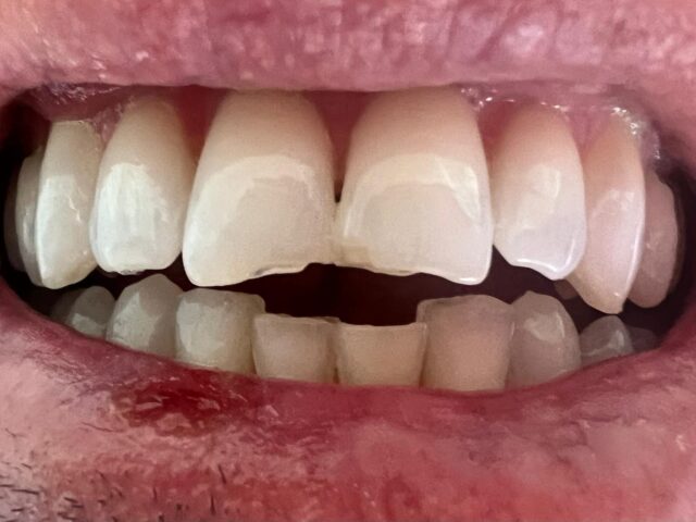 white-fillings-2b