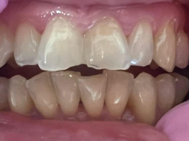 white-fillings-3a