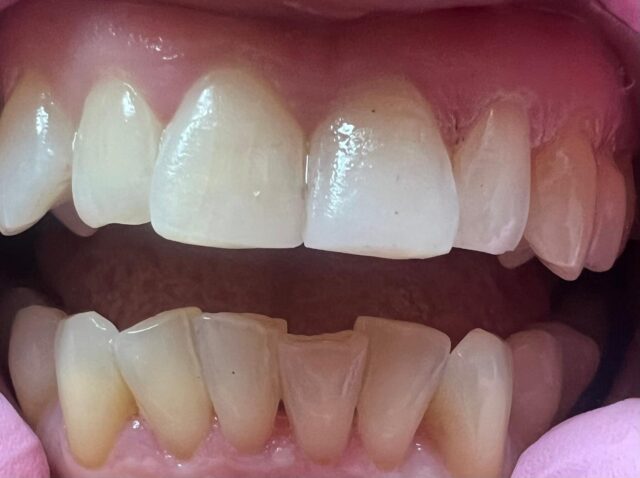 white-fillings-3b